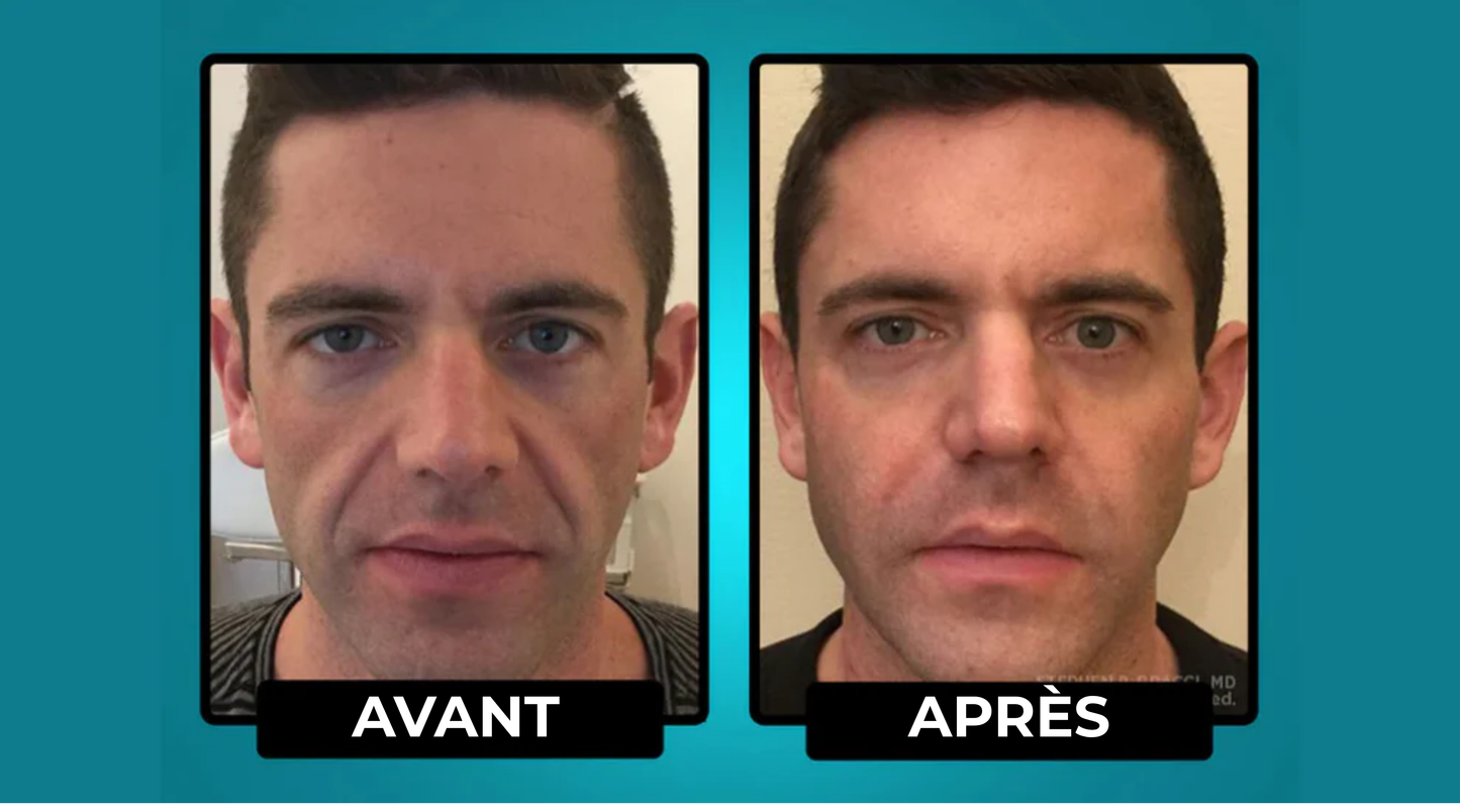 LisseÂge™ | Une Peau Visiblement Plus Ferme en 20 Secondes Par Jour. ✨🕰️